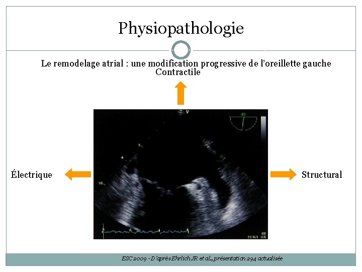 Physiopathologie Le remodelage atrial : une modification progressive de l’oreillette gauche Contractile Structural Électrique