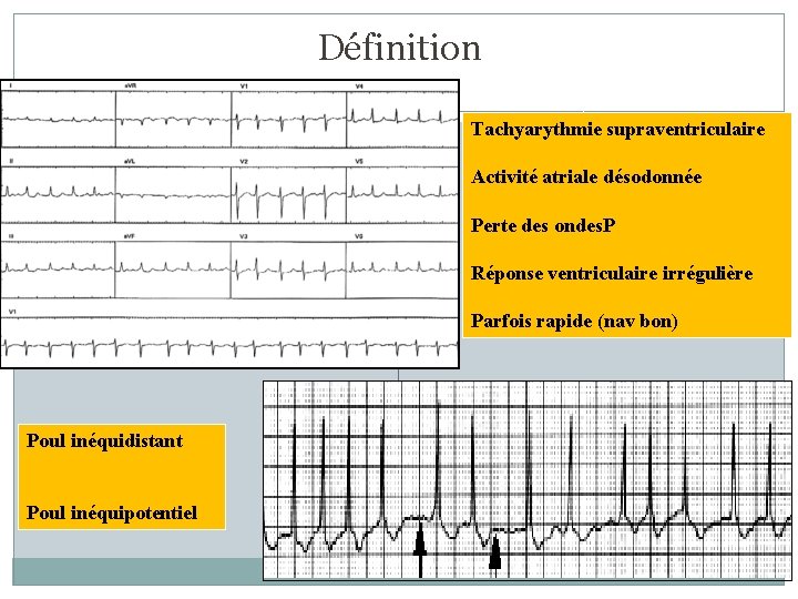 Définition Tachyarythmie supraventriculaire Activité atriale désodonnée Perte des ondes. P Réponse ventriculaire irrégulière Parfois