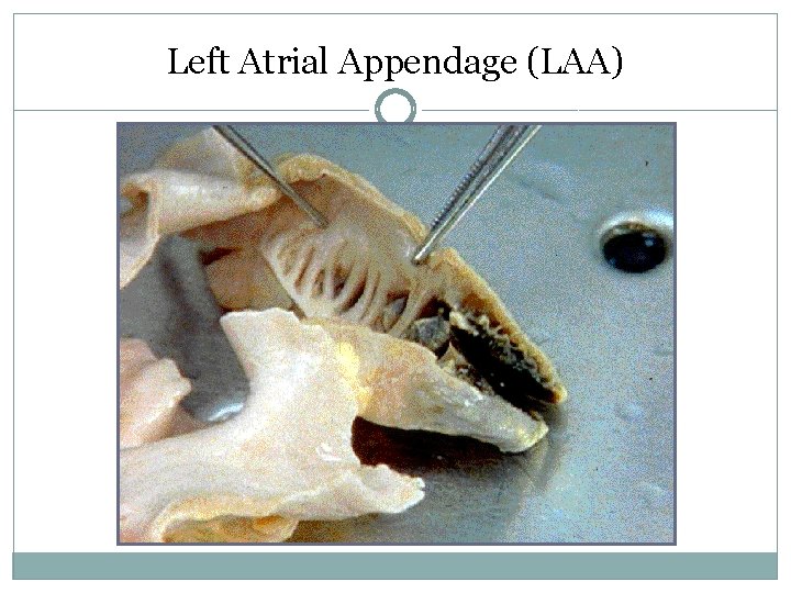 Left Atrial Appendage (LAA) 