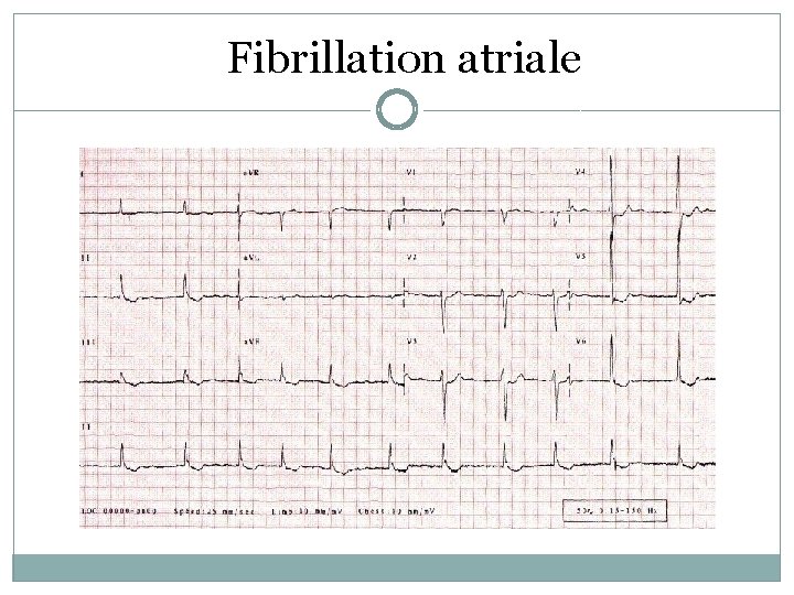 Fibrillation atriale 