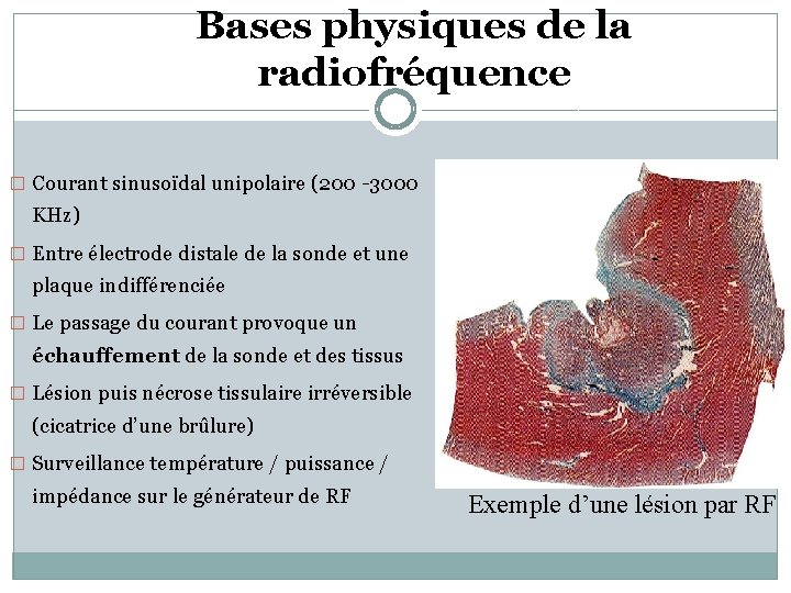 Bases physiques de la radiofréquence � Courant sinusoïdal unipolaire (200 -3000 KHz) � Entre