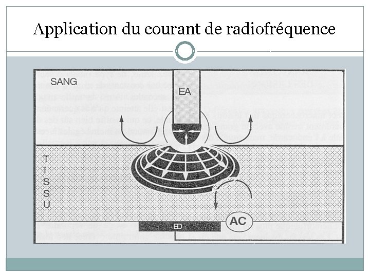 Application du courant de radiofréquence 