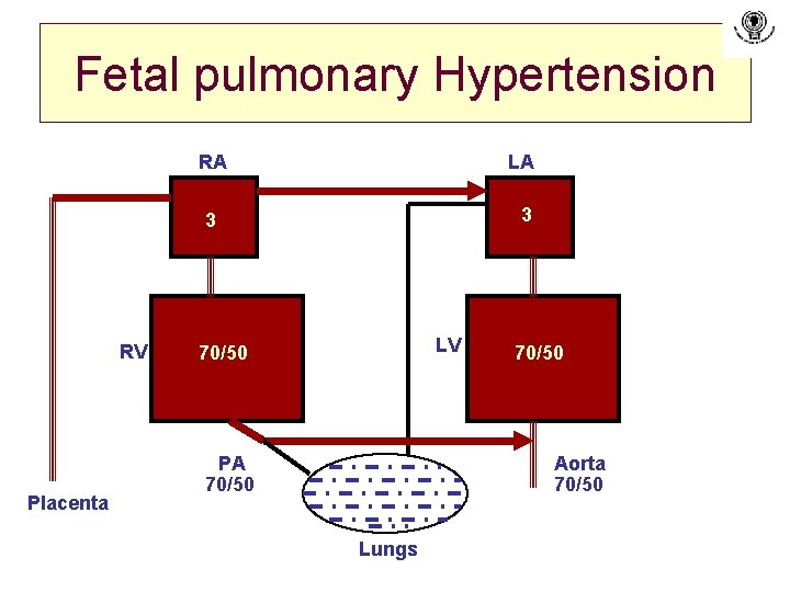 Fetal pulmonary Hypertension RV Placenta RA LA 3 3 LV 70/50 PA 70/50 Aorta