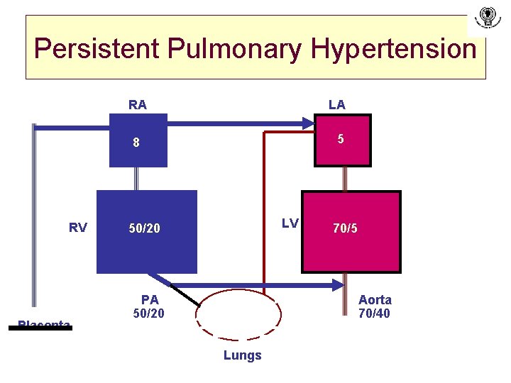 Persistent Pulmonary Hypertension RV Placenta RA LA 8 5 LV 50/20 PA 50/20 70/5