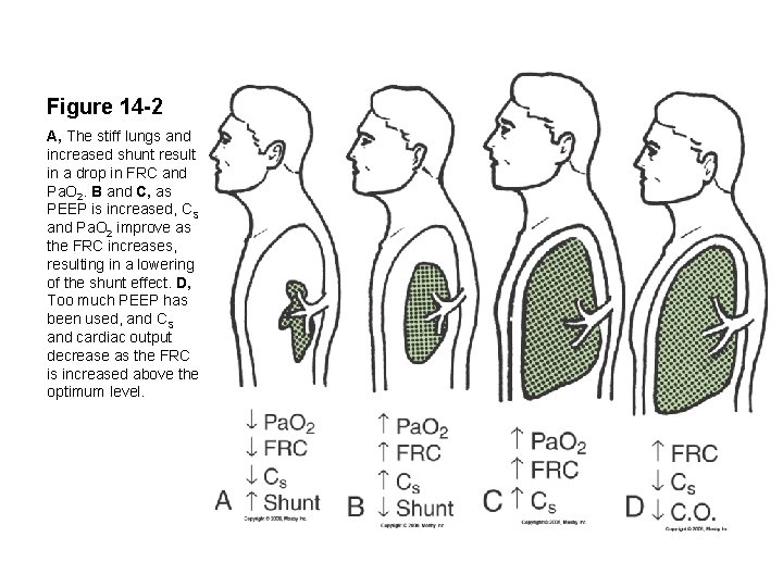 Figure 14 -2 A, The stiff lungs and increased shunt result in a drop