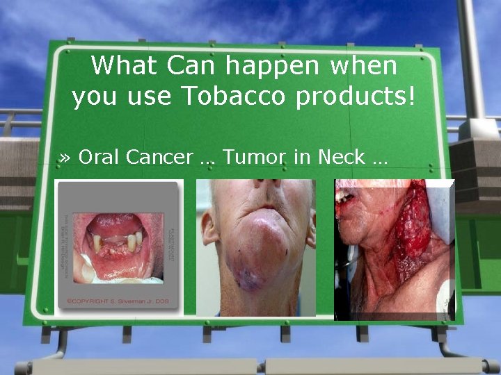 What Can happen when you use Tobacco products! » Oral Cancer … Tumor in