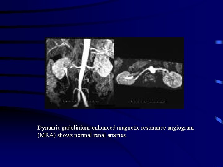 Dynamic gadolinium-enhanced magnetic resonance angiogram (MRA) shows normal renal arteries. 