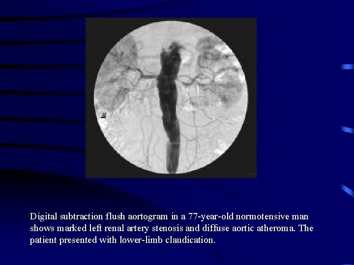 Digital subtraction flush aortogram in a 77 -year-old normotensive man shows marked left renal