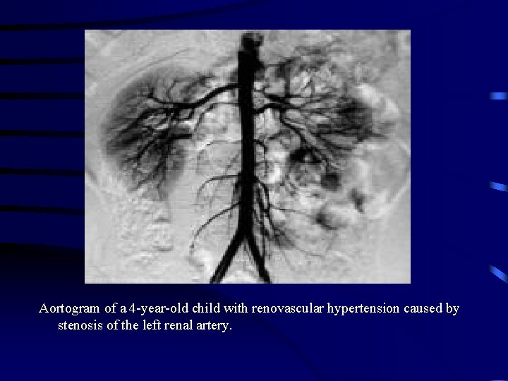 Aortogram of a 4 -year-old child with renovascular hypertension caused by stenosis of the