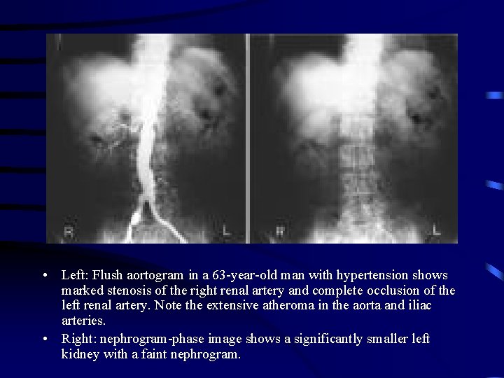  • Left: Flush aortogram in a 63 -year-old man with hypertension shows marked