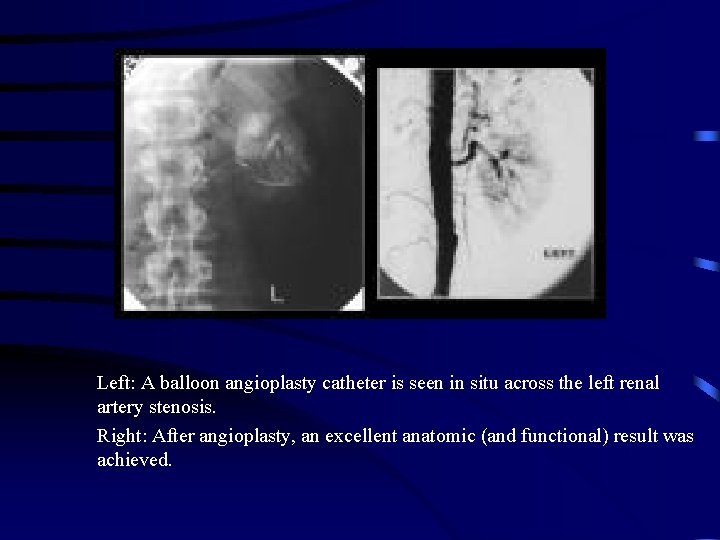 Left: A balloon angioplasty catheter is seen in situ across the left renal artery