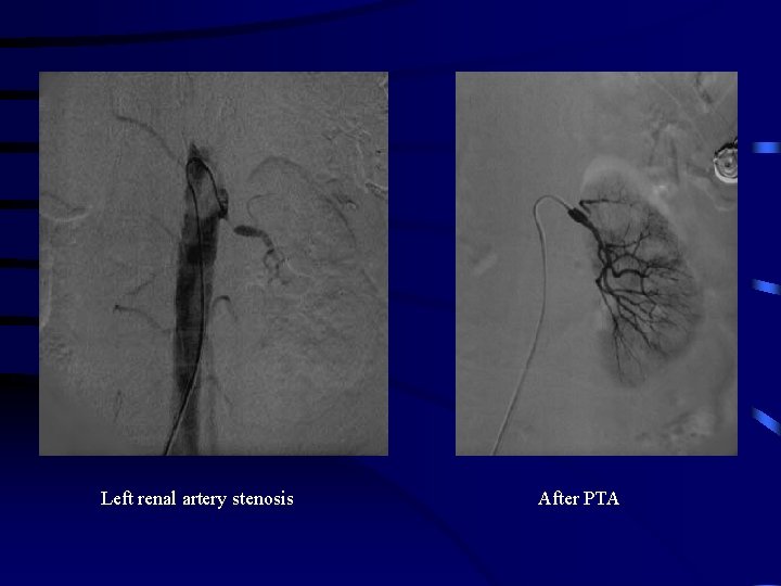 Left renal artery stenosis After PTA 