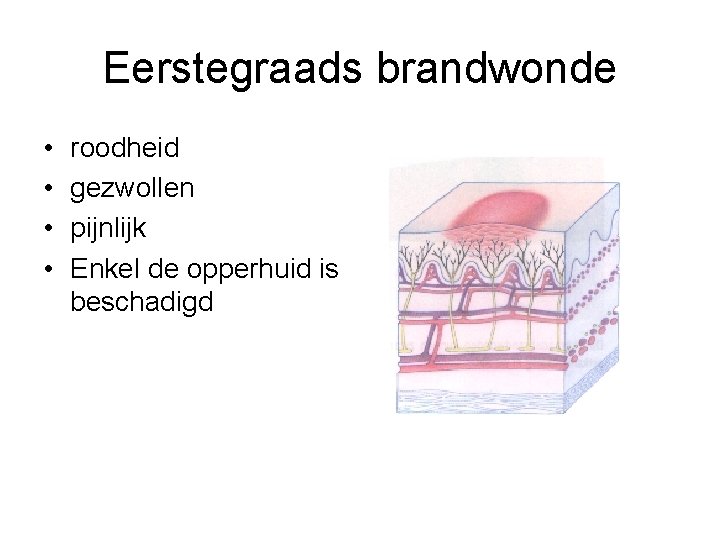 Eerstegraads brandwonde • • roodheid gezwollen pijnlijk Enkel de opperhuid is beschadigd 