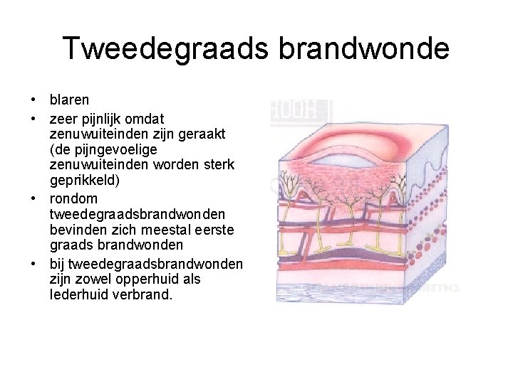Tweedegraads brandwonde • blaren • zeer pijnlijk omdat zenuwuiteinden zijn geraakt (de pijngevoelige zenuwuiteinden