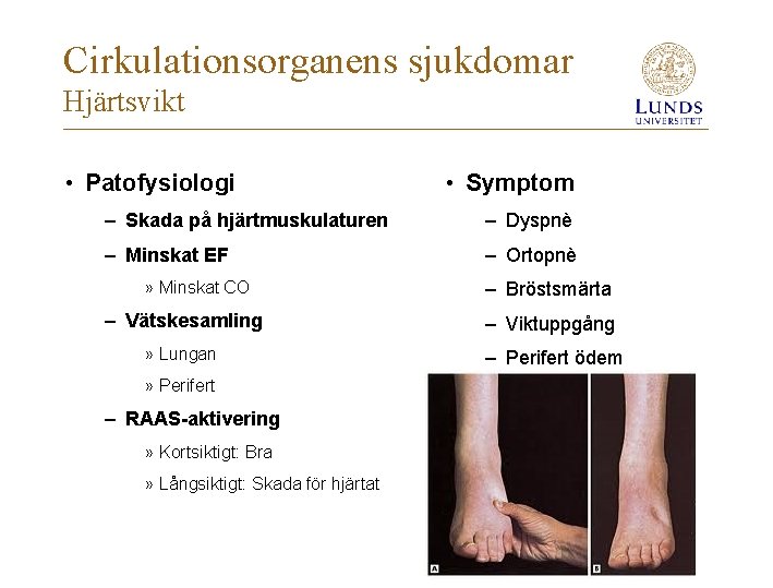 Cirkulationsorganens sjukdomar Hjärtsvikt • Patofysiologi • Symptom – Skada på hjärtmuskulaturen – Dyspnè –