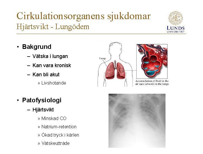 Cirkulationsorganens sjukdomar Hjärtsvikt - Lungödem • Bakgrund – Vätska i lungan – Kan vara