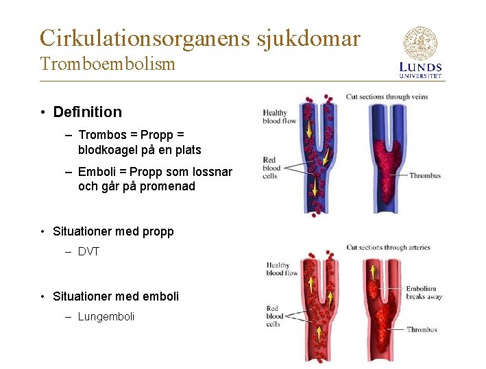 Cirkulationsorganens sjukdomar Tromboembolism • Definition – Trombos = Propp = blodkoagel på en plats