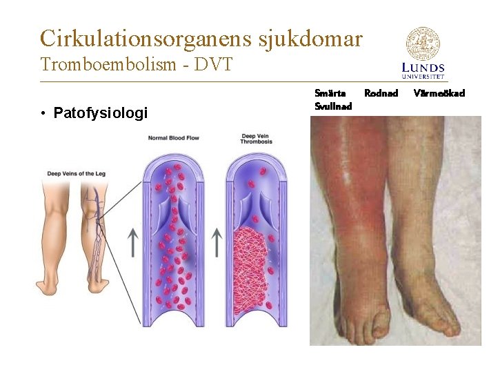 Cirkulationsorganens sjukdomar Tromboembolism - DVT • Patofysiologi Smärta Svullnad Rodnad Värmeökad 