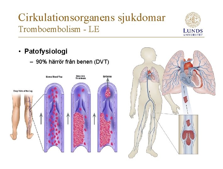Cirkulationsorganens sjukdomar Tromboembolism - LE • Patofysiologi – 90% härrör från benen (DVT) 