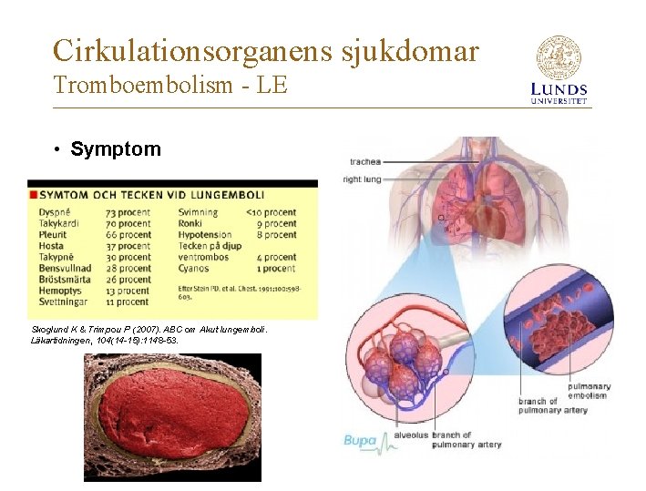 Cirkulationsorganens sjukdomar Tromboembolism - LE • Symptom Skoglund K & Trimpou P (2007). ABC