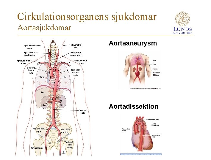 Cirkulationsorganens sjukdomar Aortaaneurysm Aortadissektion 