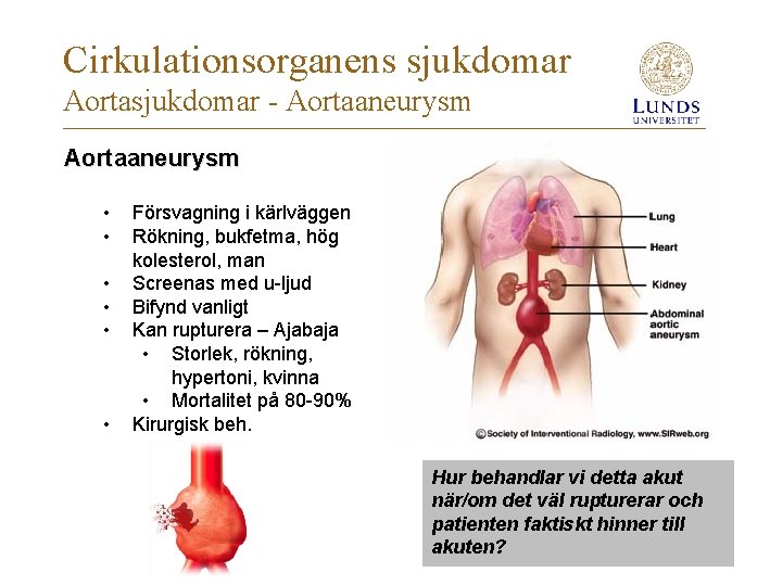 Cirkulationsorganens sjukdomar Aortasjukdomar - Aortaaneurysm • • • Försvagning i kärlväggen Rökning, bukfetma, hög