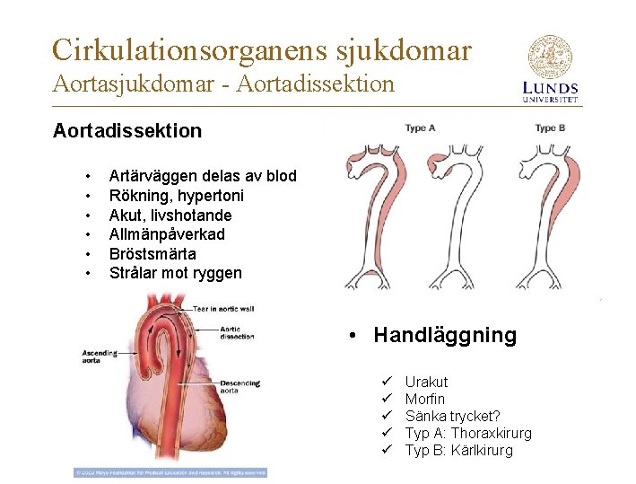 Cirkulationsorganens sjukdomar Aortasjukdomar - Aortadissektion • • • Artärväggen delas av blod Rökning, hypertoni