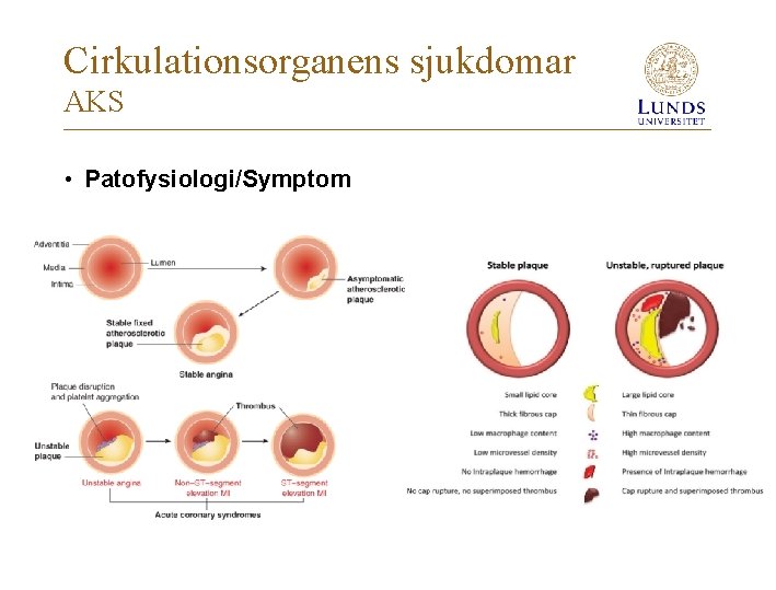 Cirkulationsorganens sjukdomar AKS • Patofysiologi/Symptom 