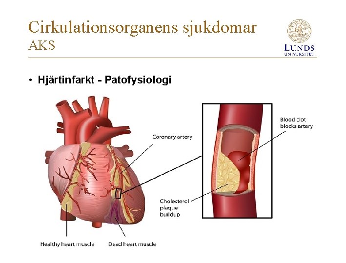 Cirkulationsorganens sjukdomar AKS • Hjärtinfarkt - Patofysiologi 