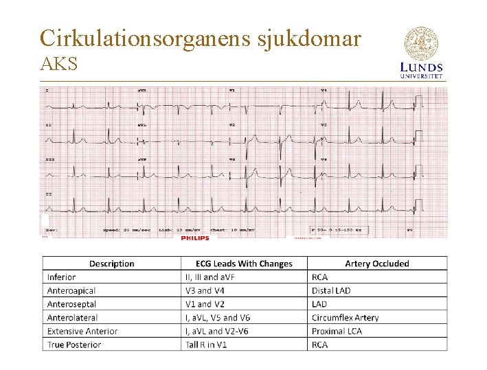 Cirkulationsorganens sjukdomar AKS 