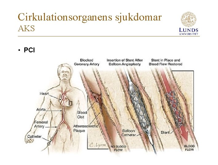 Cirkulationsorganens sjukdomar AKS • PCI 