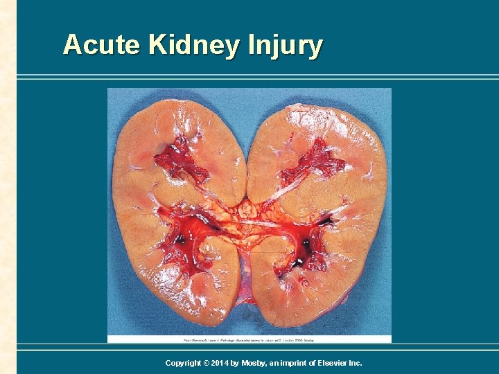 Acute Kidney Injury Copyright © 2014 by Mosby, an imprint of Elsevier Inc. 