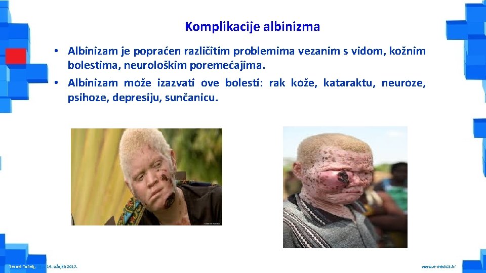 Komplikacije albinizma • Albinizam je popraćen različitim problemima vezanim s vidom, kožnim bolestima, neurološkim