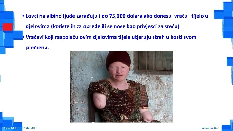  • Lovci na albino ljude zarađuju i do 75, 000 dolara ako donesu