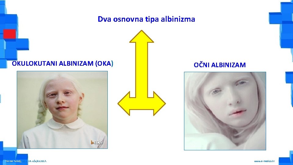 Dva osnovna tipa albinizma OKULOKUTANI ALBINIZAM (OKA) Terme Tuhelj, 16. – 19. ožujka 2017.