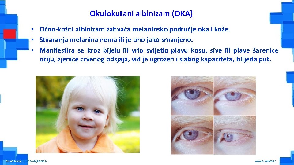 Okulokutani albinizam (OKA) • Očno-kožni albinizam zahvaća melaninsko područje oka i kože. • Stvaranja