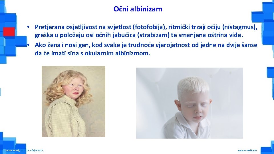 Očni albinizam • Pretjerana osjetljivost na svjetlost (fotofobija), ritmički trzaji očiju (nistagmus), greška u
