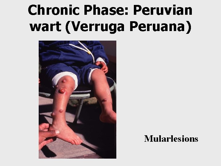 Chronic Phase: Peruvian wart (Verruga Peruana) Mularlesions 