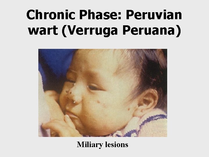 Chronic Phase: Peruvian wart (Verruga Peruana) Miliary lesions 