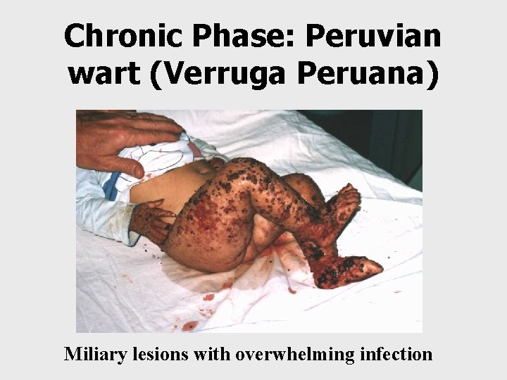 Chronic Phase: Peruvian wart (Verruga Peruana) Miliary lesions with overwhelming infection 