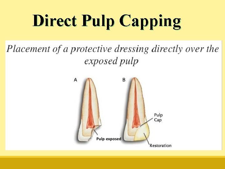 Direct Pulp Capping 