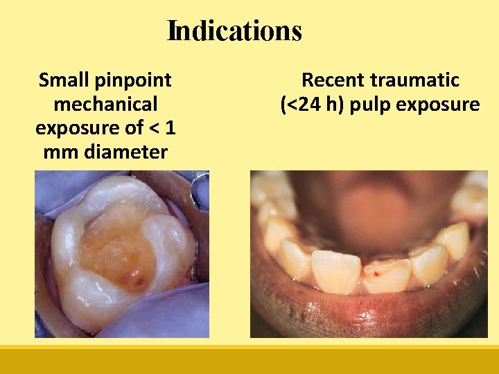 Indications Small pinpoint mechanical exposure of < 1 mm diameter Recent traumatic (<24 h)