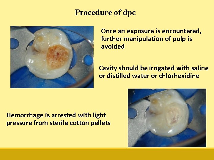 Procedure of dpc Once an exposure is encountered, further manipulation of pulp is avoided