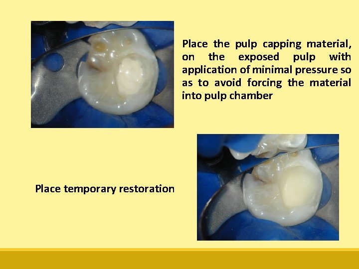 Place the pulp capping material, on the exposed pulp with application of minimal pressure