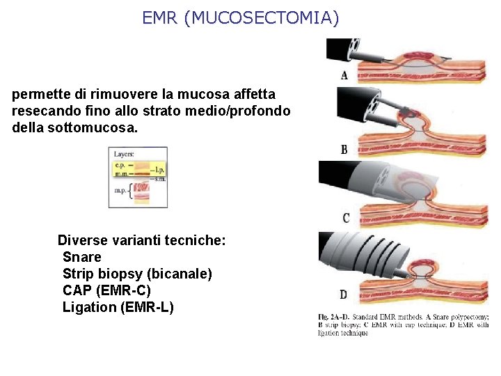 EMR (MUCOSECTOMIA) permette di rimuovere la mucosa affetta resecando fino allo strato medio/profondo della