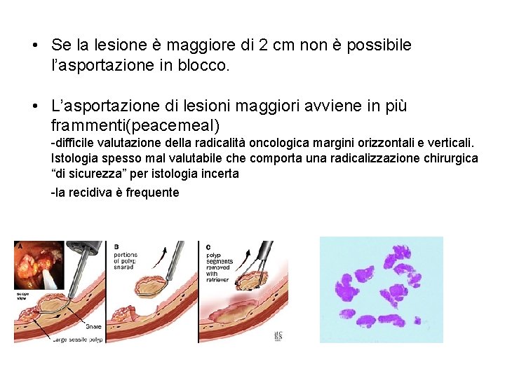  • Se la lesione è maggiore di 2 cm non è possibile l’asportazione