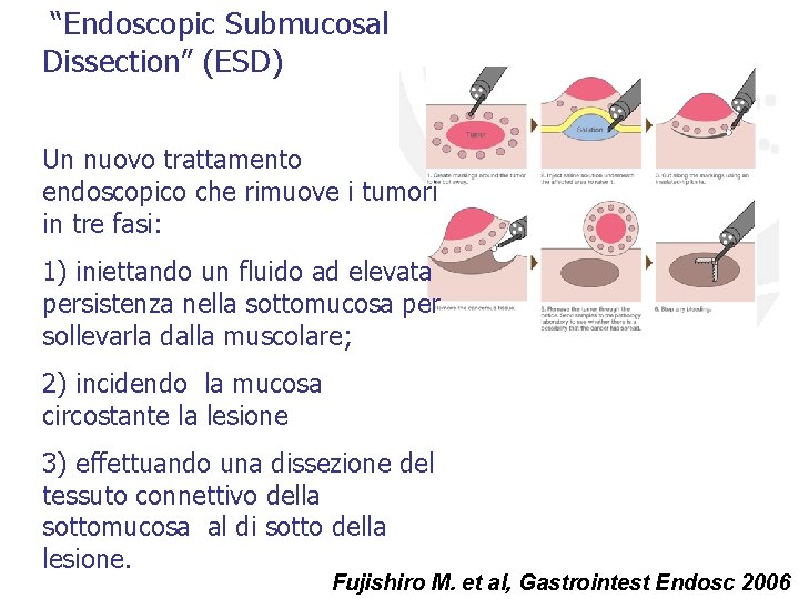 “Endoscopic Submucosal Dissection” (ESD) Un nuovo trattamento endoscopico che rimuove i tumori in tre