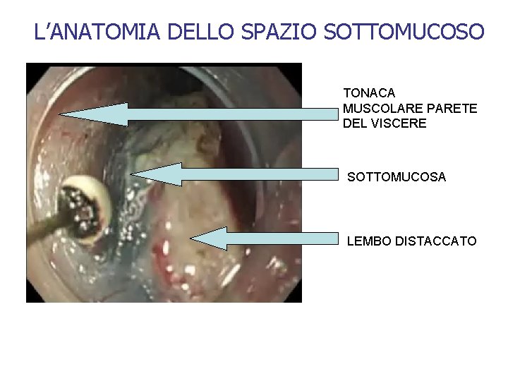 L’ANATOMIA DELLO SPAZIO SOTTOMUCOSO TONACA MUSCOLARE PARETE DEL VISCERE SOTTOMUCOSA LEMBO DISTACCATO 