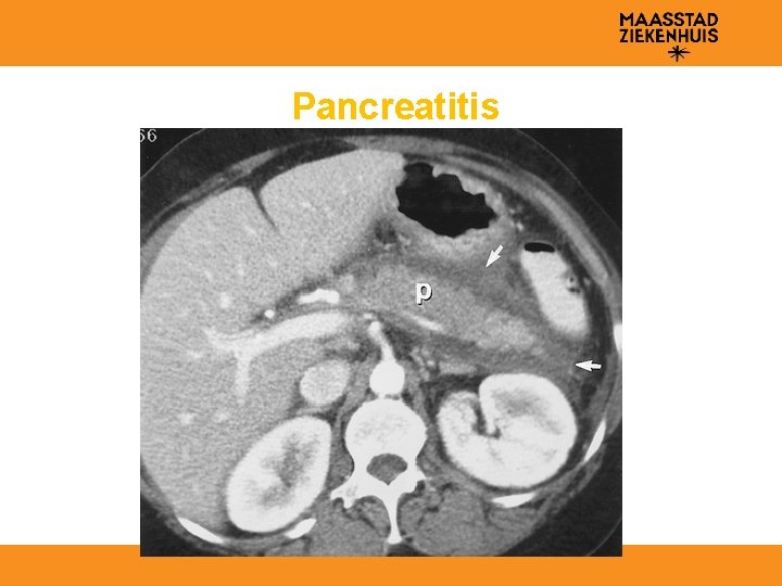 Pancreatitis 