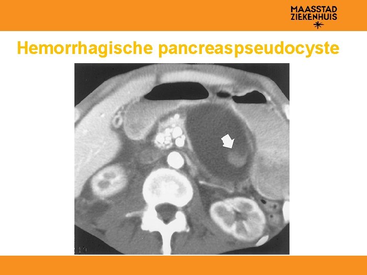 Hemorrhagische pancreaspseudocyste 